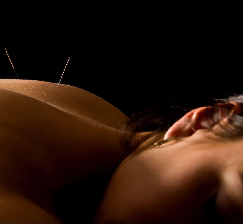 Woman Acupuncture Treatment